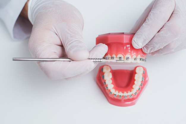 Model aparat dentar - Servicii ortodontie Clinica SyroDent