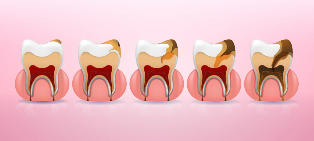Evolutia cariei dentare - Tratament prin odontoterapie