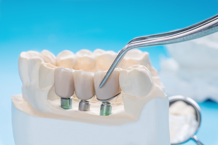 Coroana pe implant dentar - Clinica SyroDent