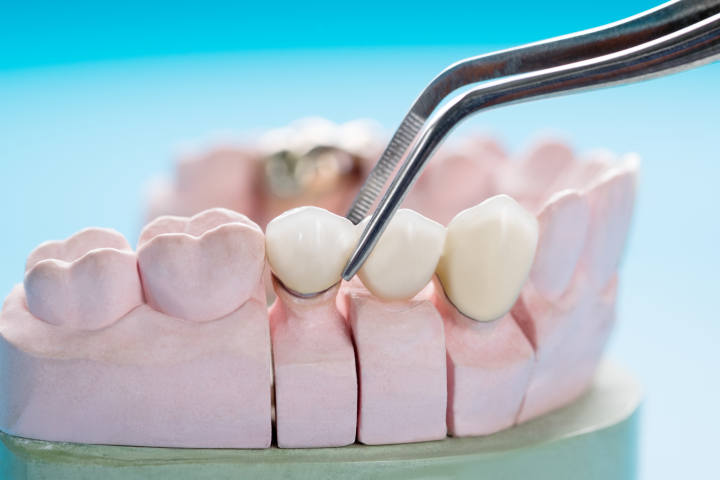 Coroana dentara - Clinica SyroDent