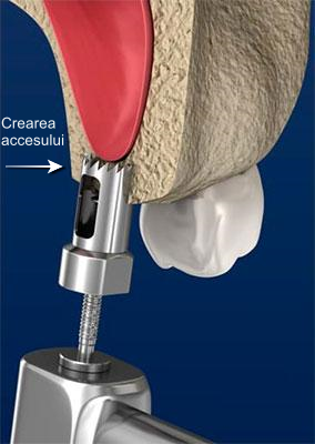 Creare acces - Operatie sinus lifting Syrodent