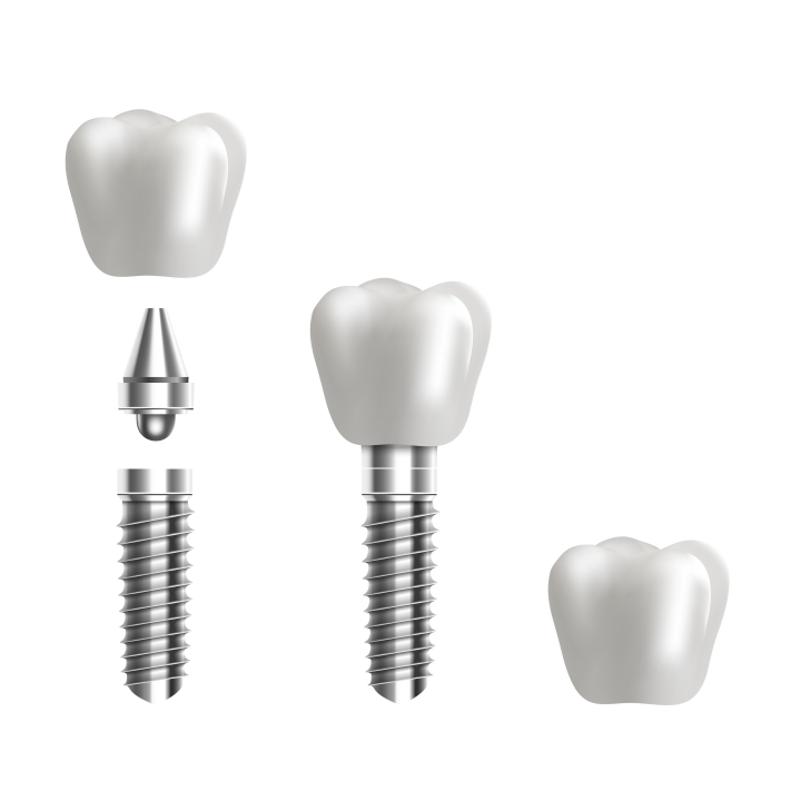Implant dentar - Clinica Syrodent Bucuresti