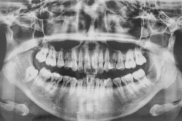 Radiografie dentara completa