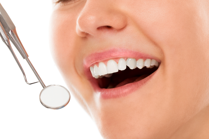 Control carie dentara - Clinica SyroDent