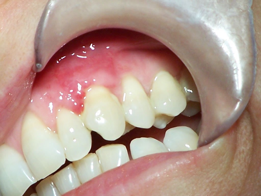 Gingie afectata de parodontoza - Parodontologie SyroDent