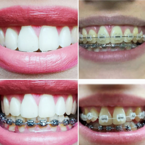 Tratament estetica dentara - Clinica SyroDent Bucuresti