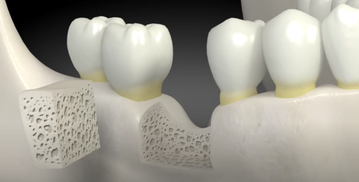 Aditie os implant dentar