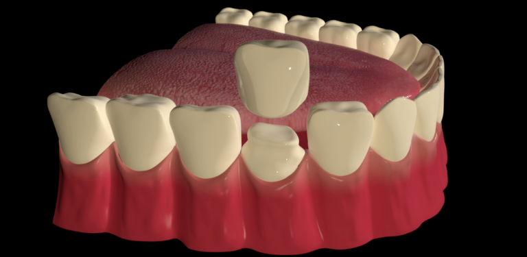 Aplicare coroana dentara - Clinica SyroDent