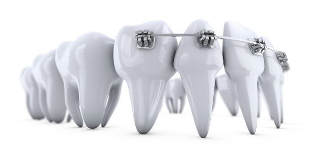 Bracketi dentari - Tratament ortodontic