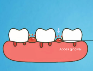 Abces gingival