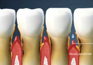 Abces parodontal
