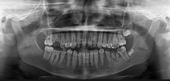 Radiografie dentara panoramica - Clinica SyroDent