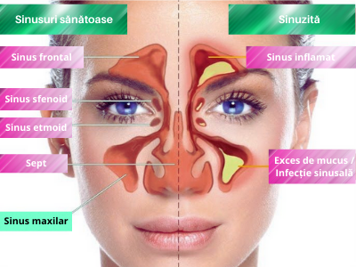 Sinuzita maxilară - Cele 4 tipuri de sinusuri