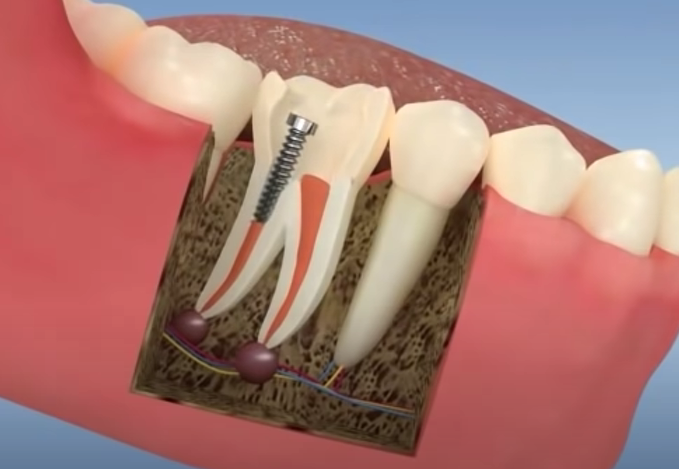 Pivot dentar - Clinica Syrodent