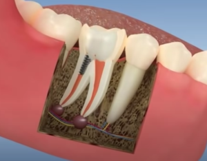 Stalp dentar - tratament de canal